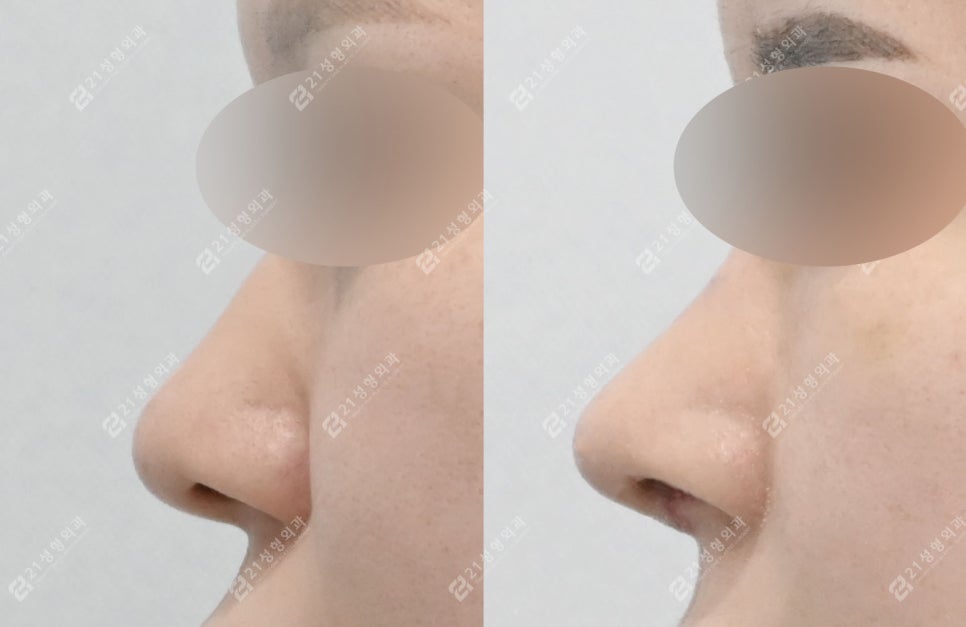 How to Create a Flawless Nose Line | Real Review of Rib Cartilage Rhinoplasty image 6