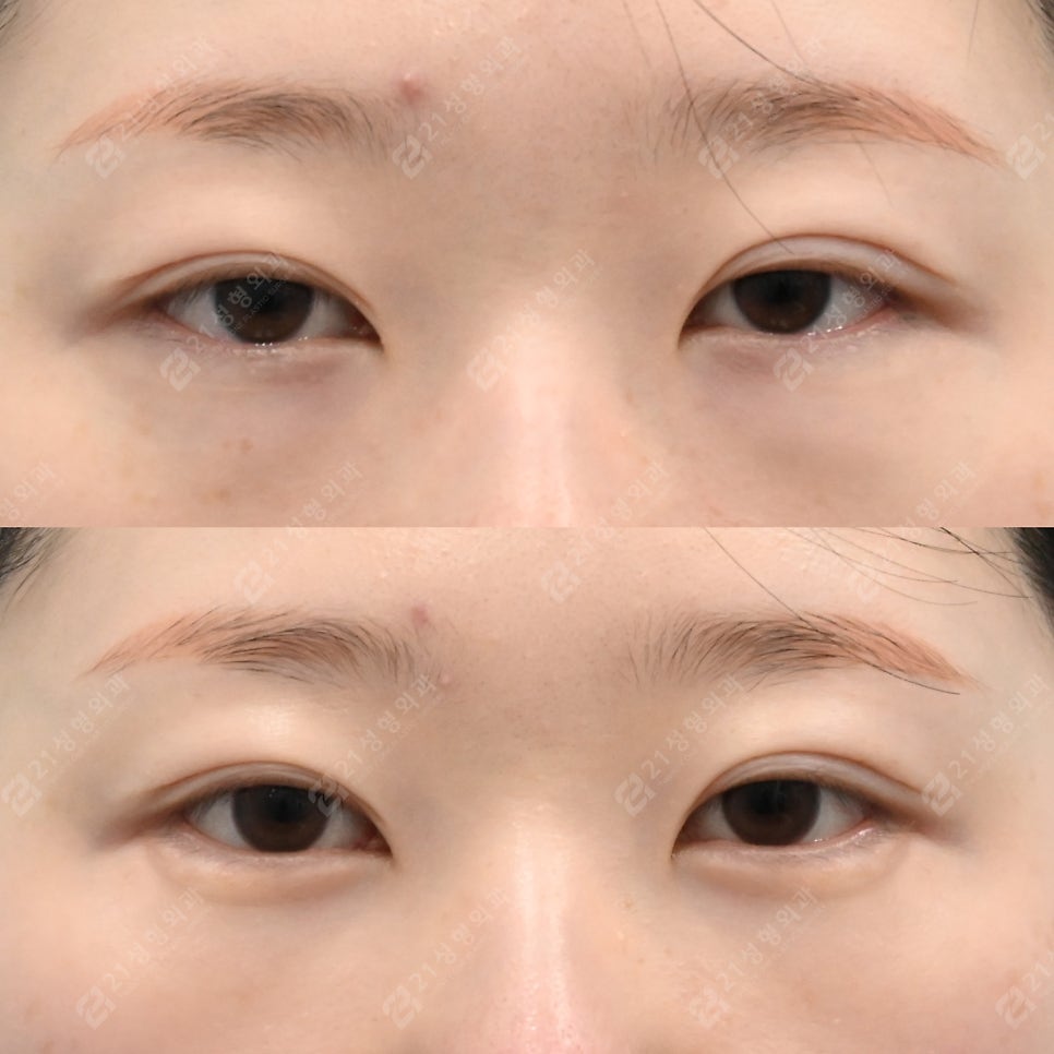 Recovery Period Before and After Lower Eyelid Fat Repositioning image 1