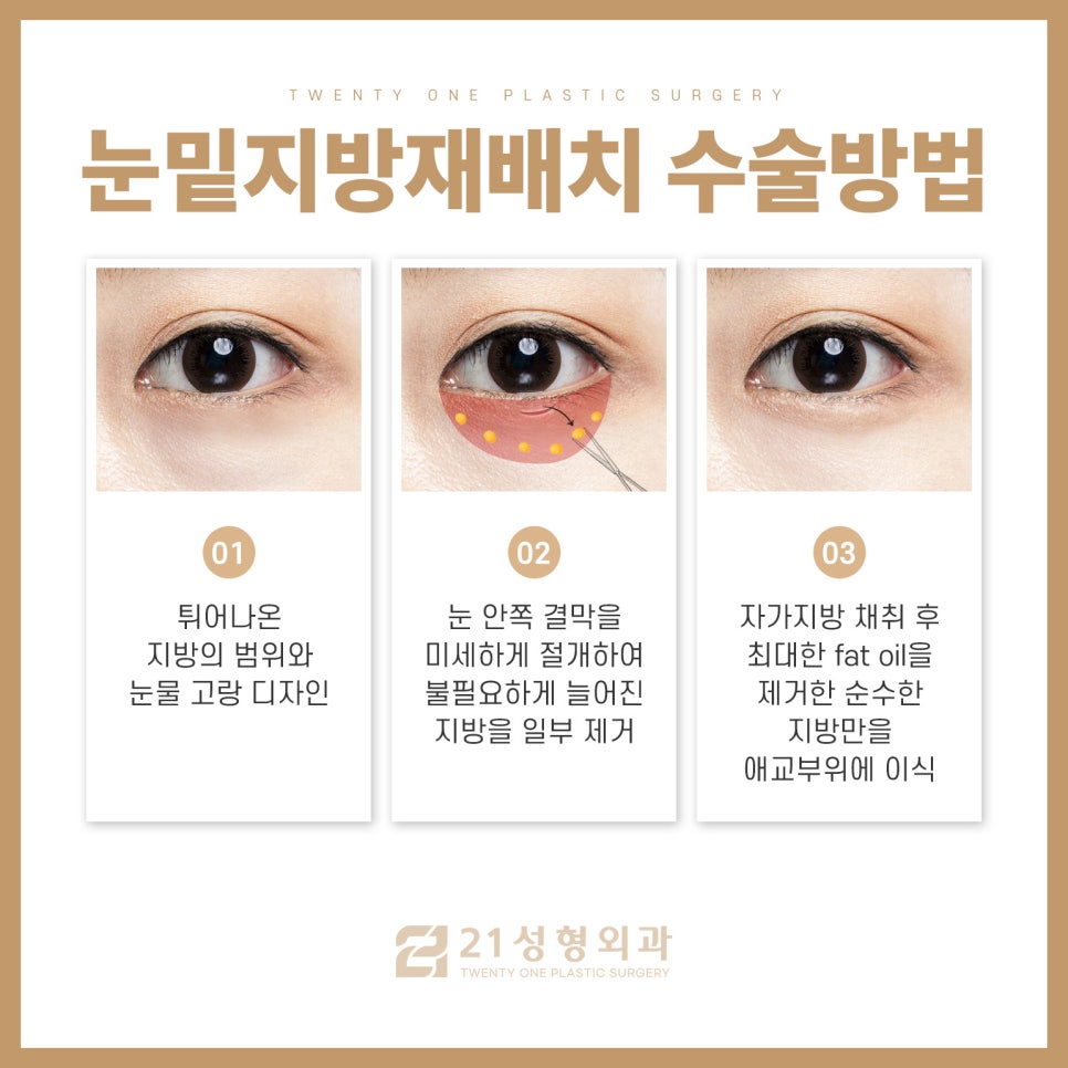강남역눈밑지방재배치 더 오래가고 확실한 방법은 관련 이미지 4