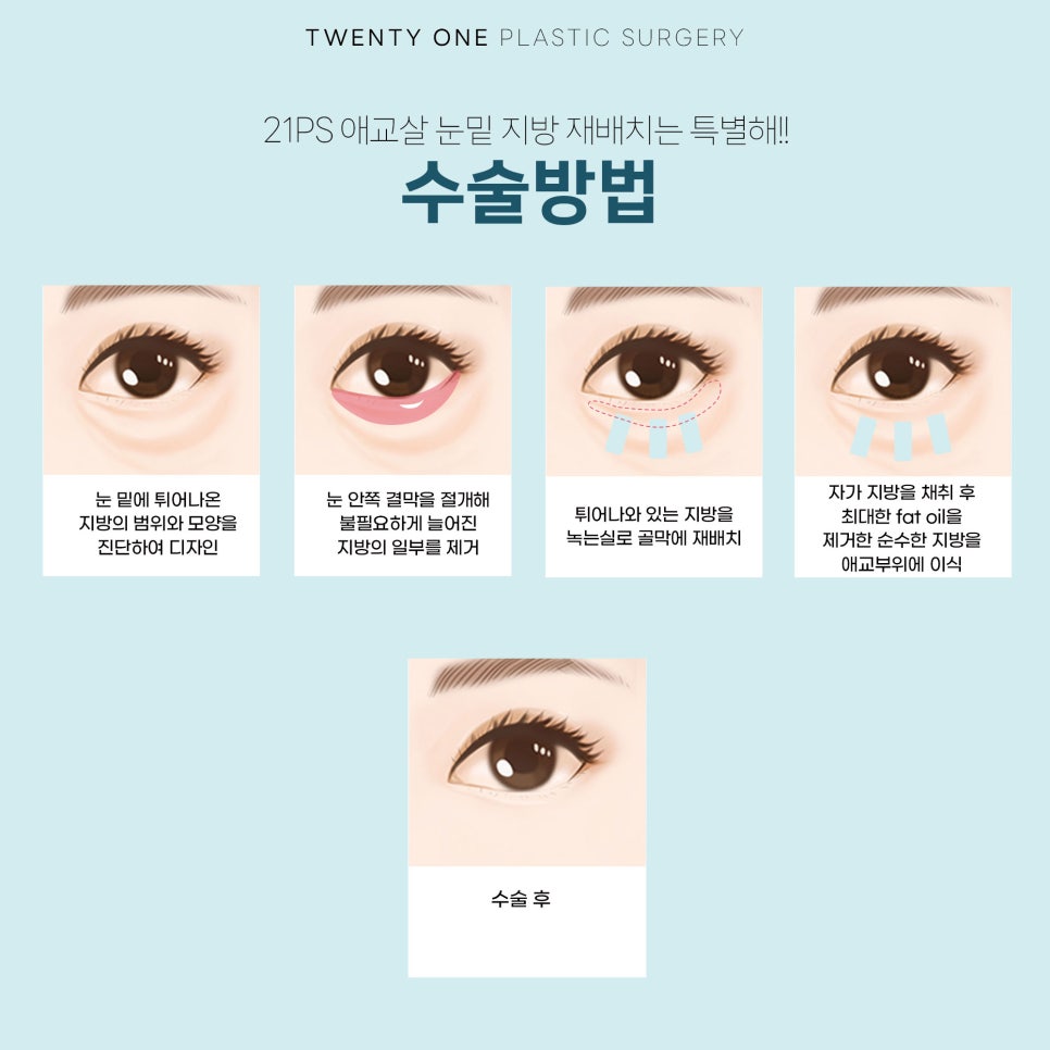 [지방재배치] 애교살 눈밑 지방 재배치는 어떤 경우 필요할까? [21성형 외과] 관련 이미지 2