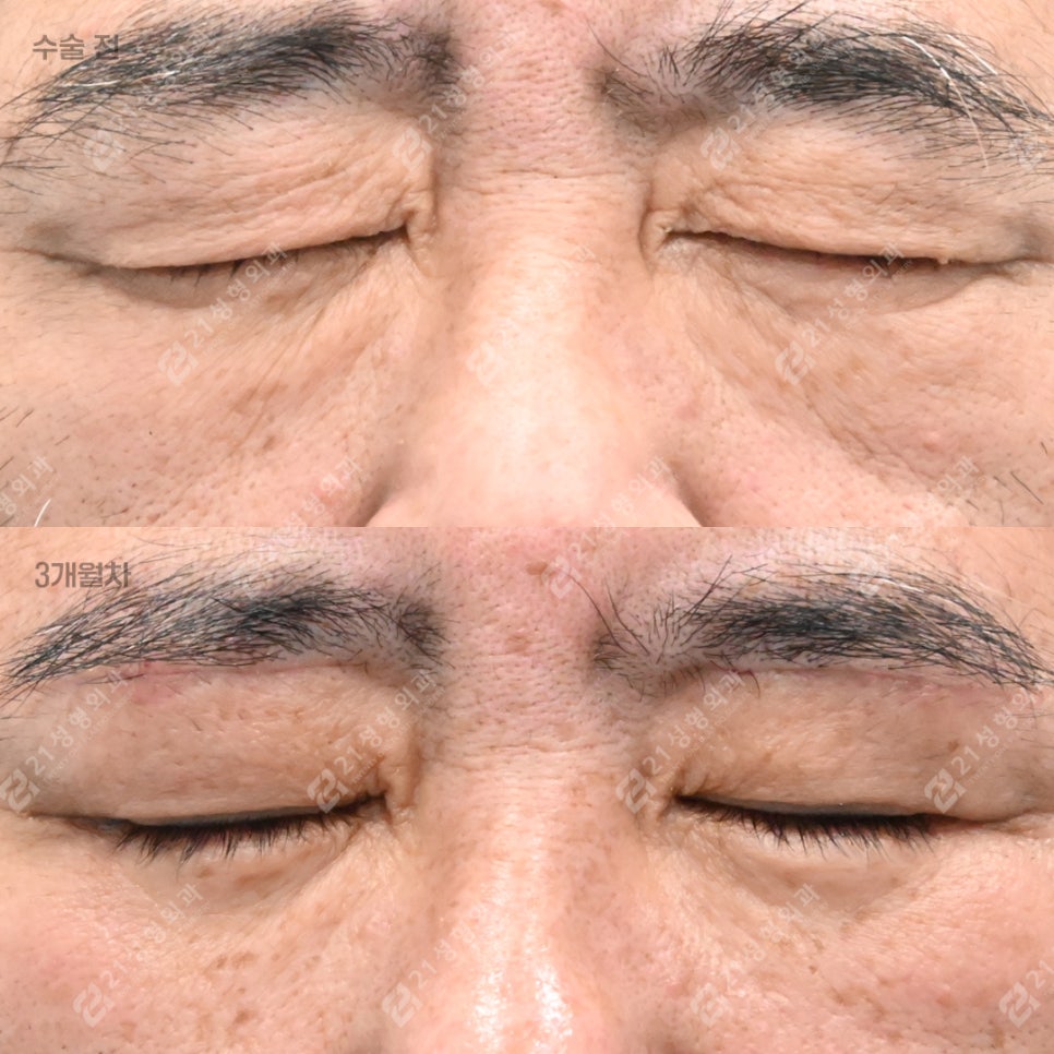눈밑 처짐으로 인상이 무너지기 전에, 21성형외과 남성 하안검 관련 이미지 4