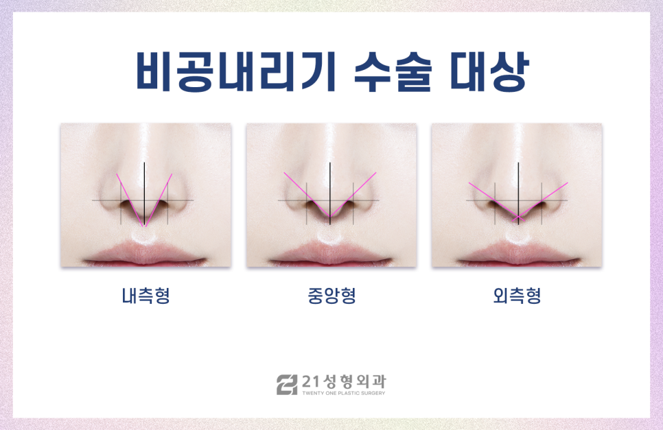 코성형잘하는곳 전체적인 비율을 고려해야 관련 이미지 2