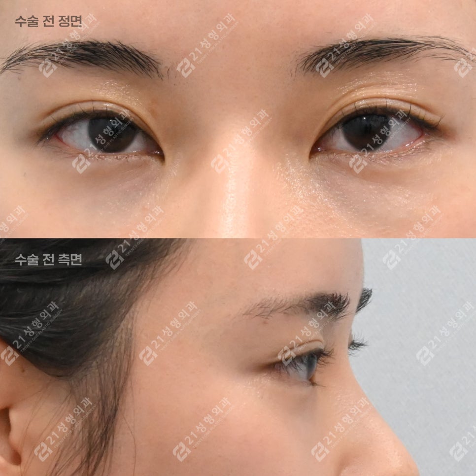 Key Points That Change Your Impression: Under-Eye Fat Repositioning and Nano-Pet Fat Grafting image 3