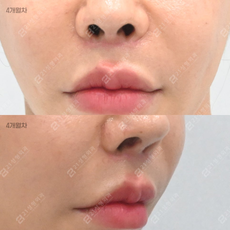 Why More People Are Seeking Philtrum Reduction Recently &ndash; 21성형외과 image 6