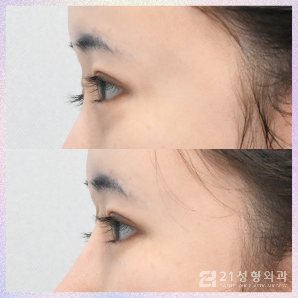 눈밑지방재배치수술잘하는곳 21성형외과에서 관련 이미지 4