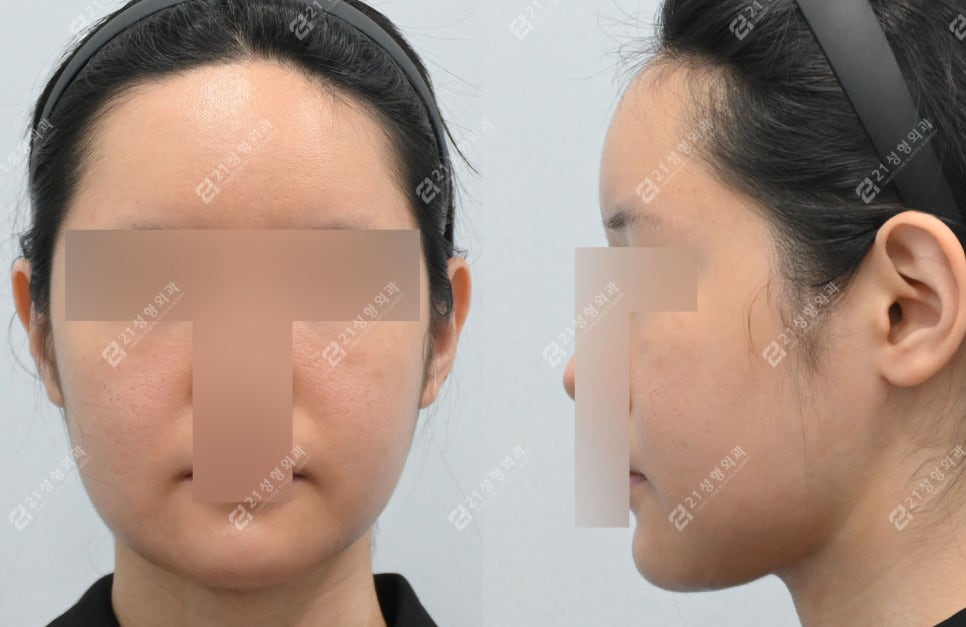 Double Chin Surgery, There Was Actually Another Cause (Real Case Analysis) image 4