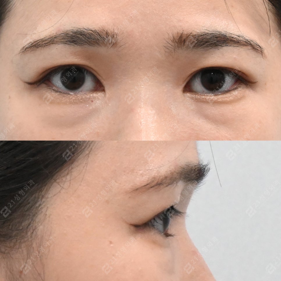 Under-eye fat that filler couldn’t hide: a 3-month and 4-month review after under-eye surgery image 2