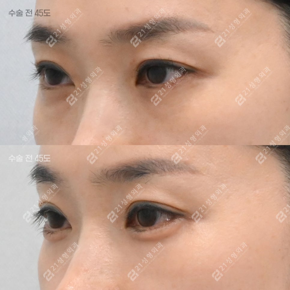 피곤해 보이던 40대 눈밑, 하안검 후 이렇게 달라졌습니다 관련 이미지 5