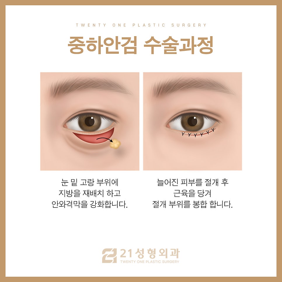 중년하안검 흉터 미리 방지 가능합니다 관련 이미지 7