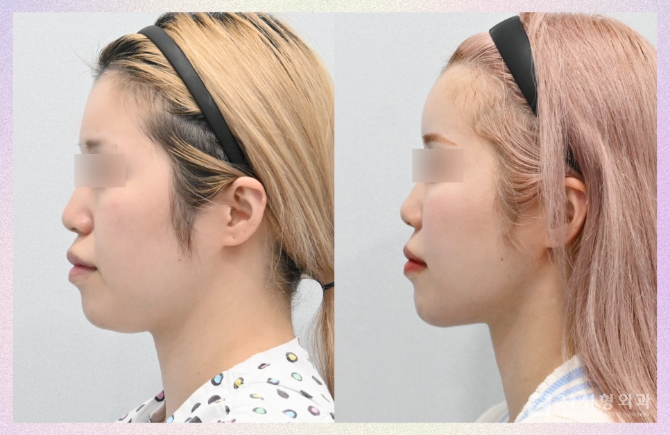 얼굴지방이식잘하는곳 노하우가 궁금하다면 관련 이미지 3