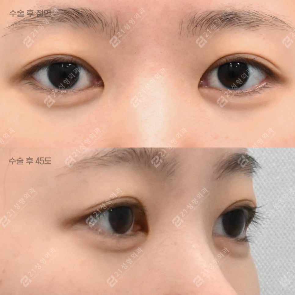 다크서클도, 애교살도 21성형외과에서 한 번에 해결! 관련 이미지 5