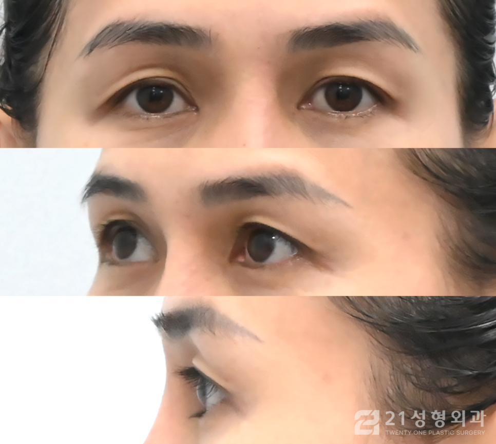 눈매교정잘하는곳 또렷해지고 싶다면 관련 이미지 4