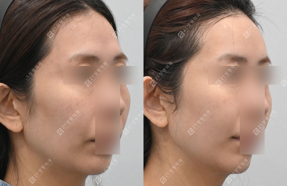 Could a lump you feel after fat grafting be cancer? image 2