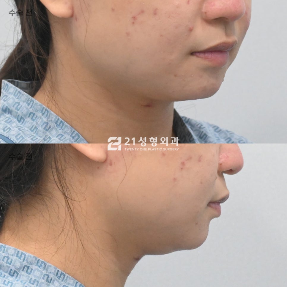 스트레스인 턱밑 살, 진짜 범인은 따로 있습니다. 관련 이미지 5