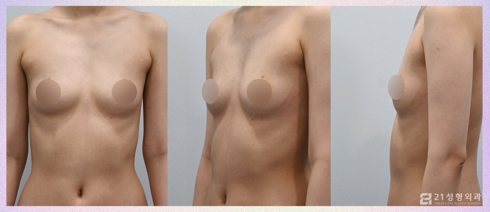 가슴성형잘하는곳 원하는 볼륨으로 확실하게 관련 이미지 7