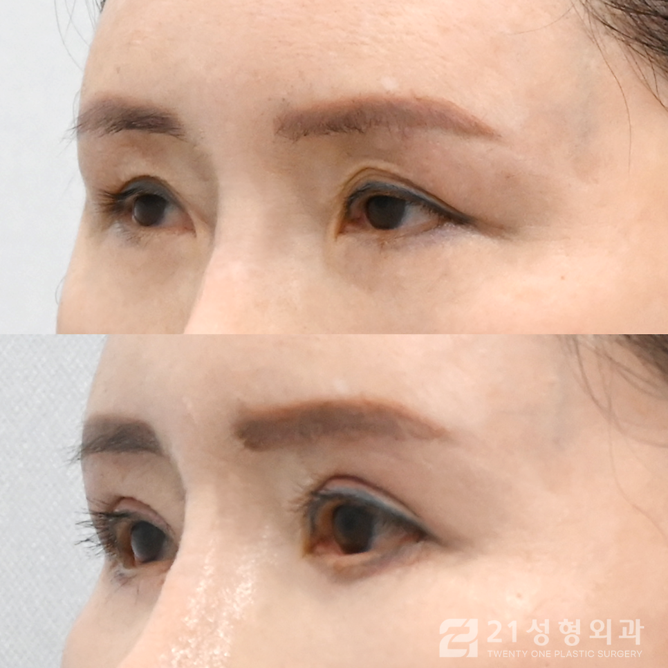 40대쌍수, 근본적인 원인부터 해결하자 관련 이미지 2