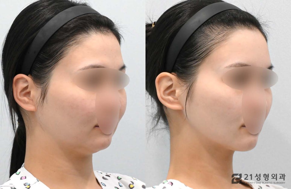얼굴자가지방이식수술 유지기간과 효과 관련 이미지 2