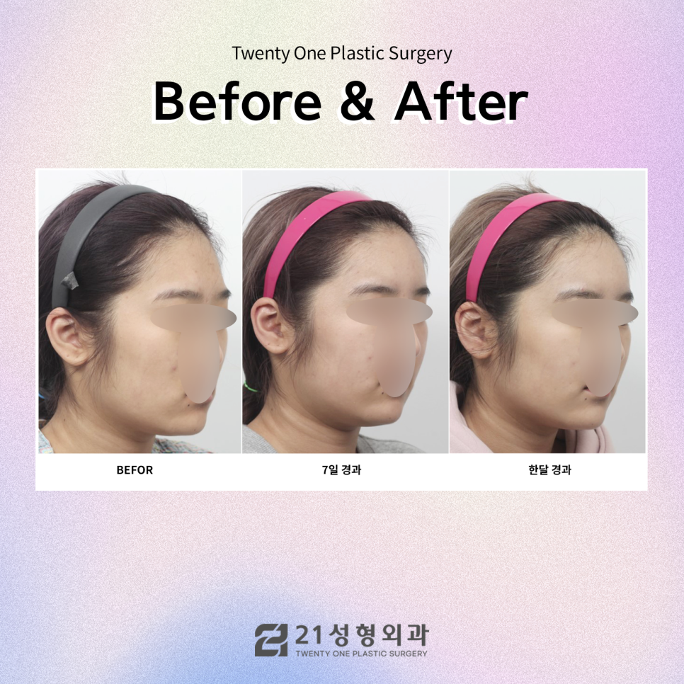 자가지방유지기간 효과를 높이려면면 관련 이미지 6