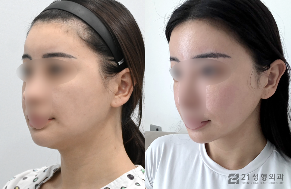 이중턱살제거수술 전 정확히 알아야 할 것 관련 이미지 2