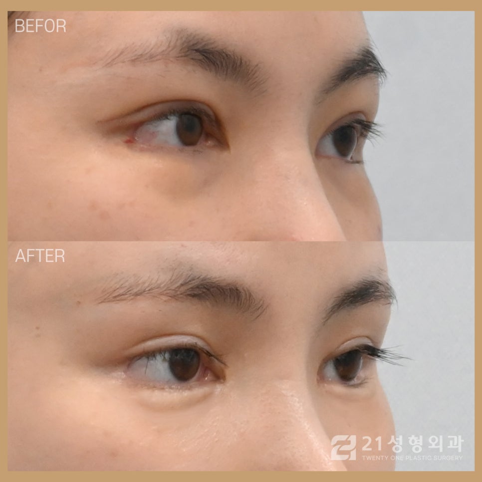애교살수술은 나노펫 지방이식으로 해결 관련 이미지 2