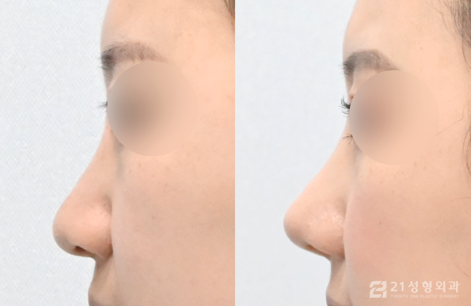 코성형잘하는곳 개인에게 맞는 자연스러운 비율 관련 이미지 3