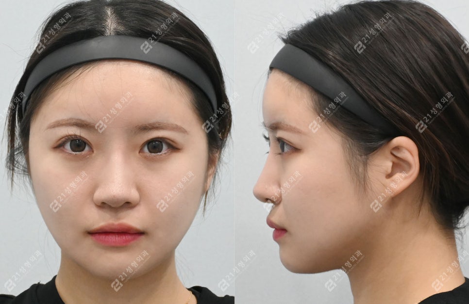 Real Review of Square Jaw Surgery: Square Jaw Surgery Is Not Over After Just Shaving the Bone image 7