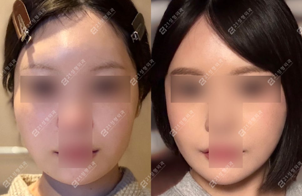 윤곽3종 케이스 분석 | 밋밋한 얼굴형이 이렇게 달라진 이유 관련 이미지 6