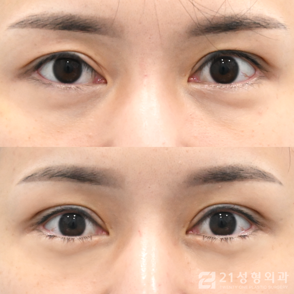 눈밑지방재배치수술병원 확실한 효과는 관련 이미지 1