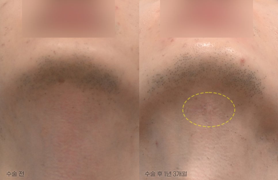 Have You Regretted Having Only Double-Chin Liposuction? Why Muscle Tightening May Be Needed for Successful Double-Chin Surgery image 5