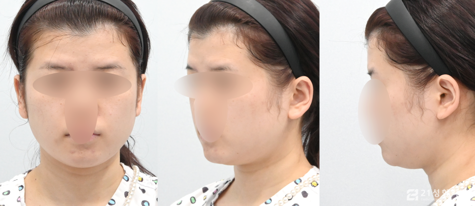 안면윤곽3종 달라지는 라인의 비결 관련 이미지 4