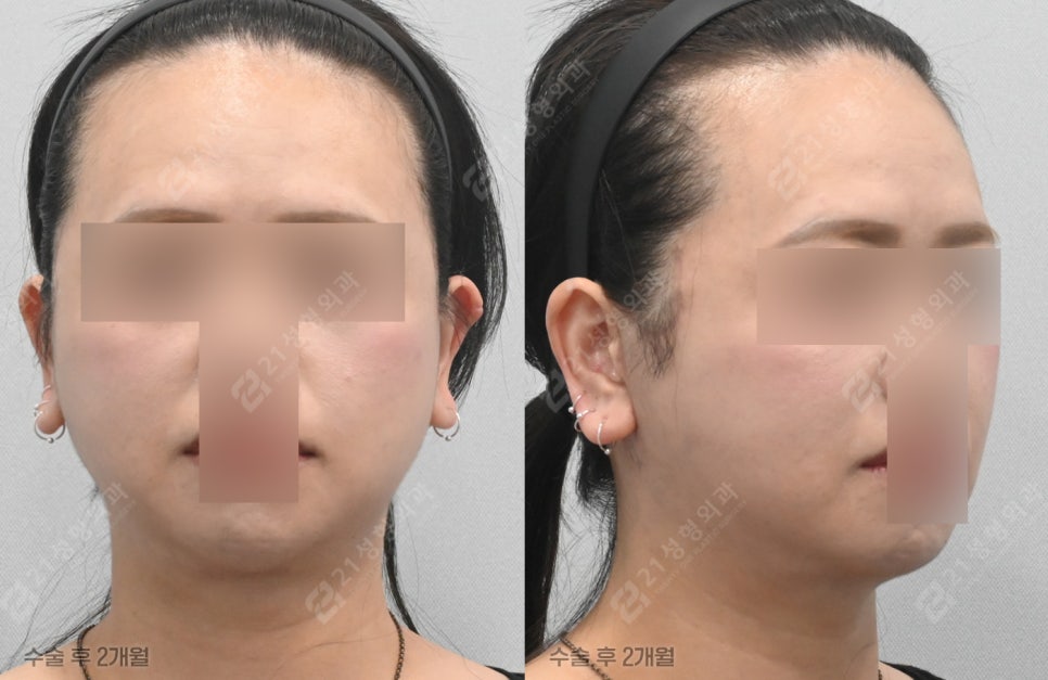 Why Does My Face Still Look the Same Even After Having Many Lifting Procedures? image 5