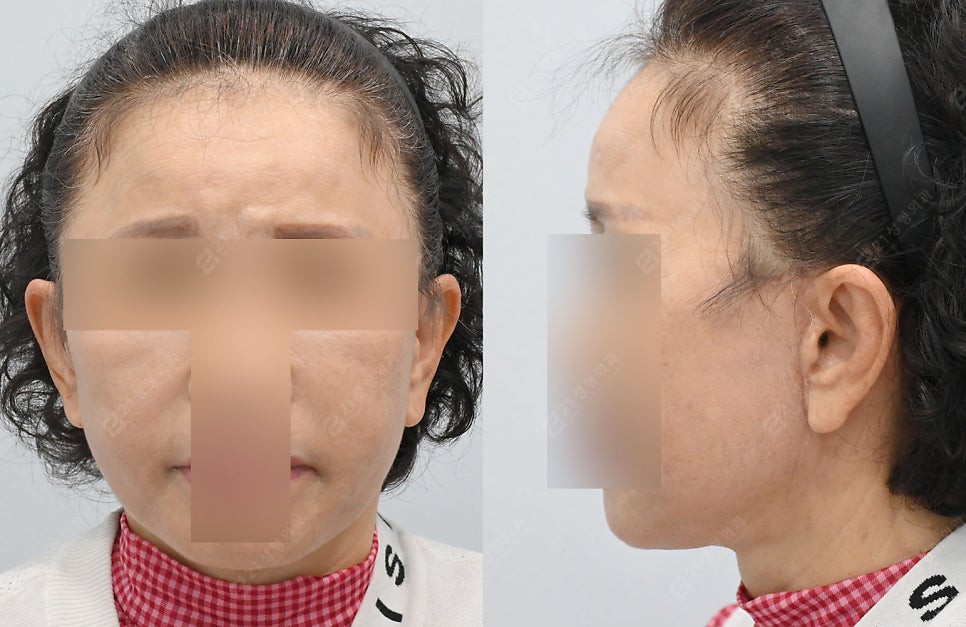 Let’s Address Facial Sagging from the Root Cause! Real Changes from a Face and Neck Lift image 4
