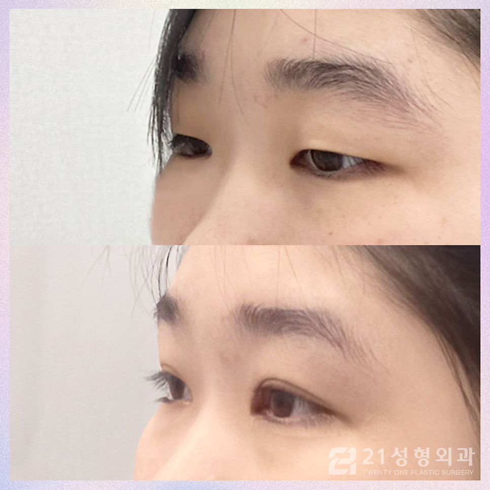쌍꺼풀절개수술 안검하수를 효과적으로 개선하는 방법 관련 이미지 4