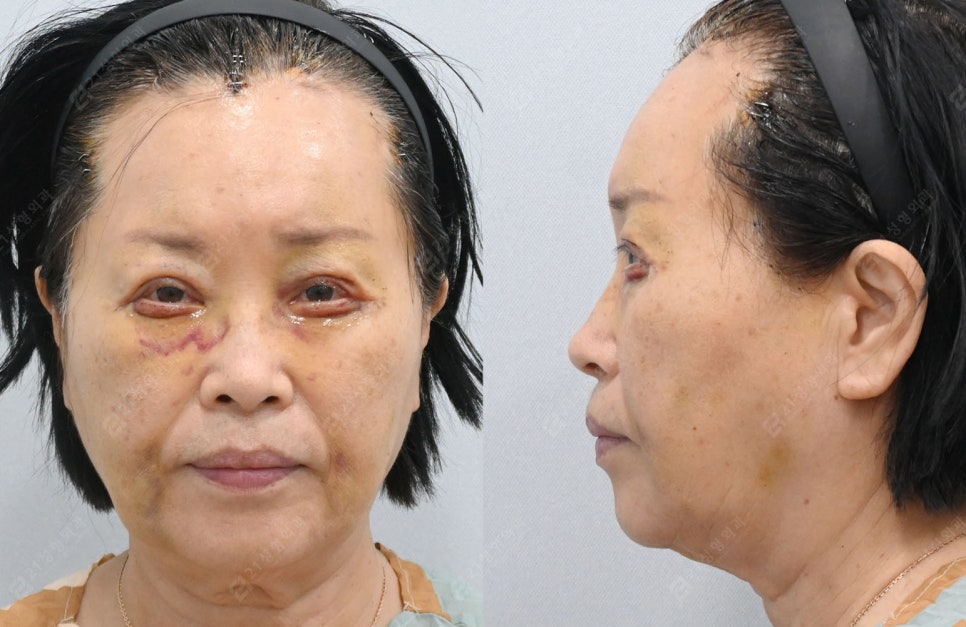 자연스럽게 젊어지고 싶다면? 중년 수술 이마거상, 상.하안검으로 해결! 관련 이미지 3