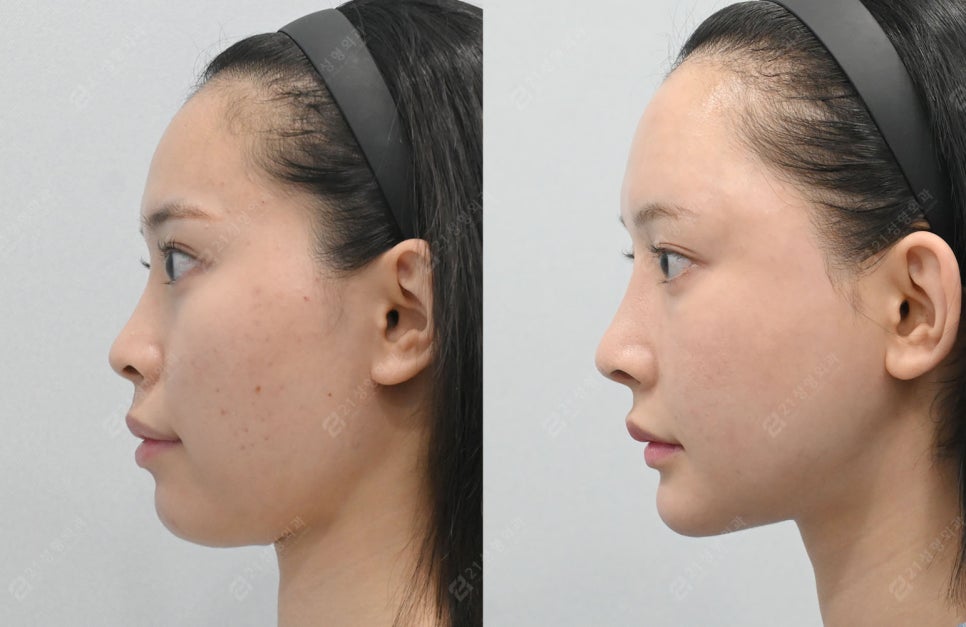 Facial Contouring, Key Points You Must Know: A Real Review of Changes Over 1 Year and 6 Months image 8