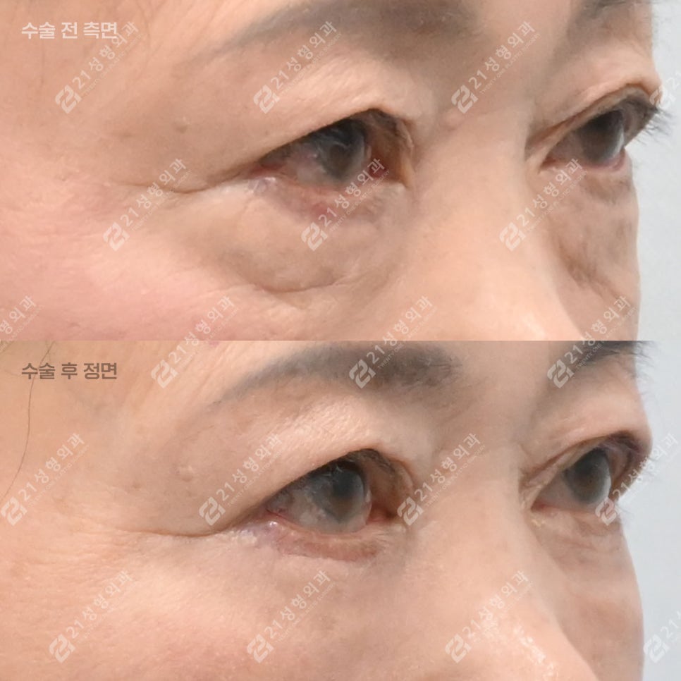 이거 모르면 하안검 수술 절대 하지 마세요! 관련 이미지 4