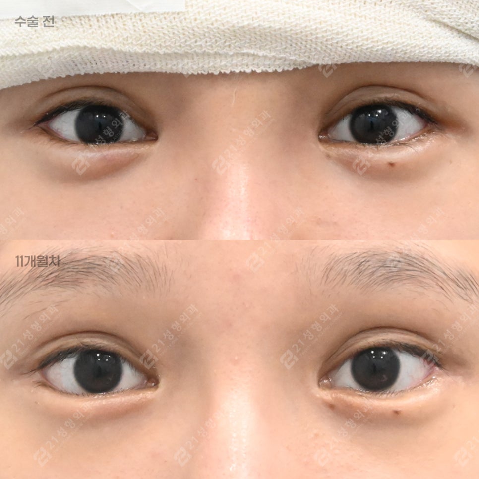 The Golden Time to Correct Failed Eye Corners? Essential Checklist for Lateral & Lower Canthoplasty Revision image 1