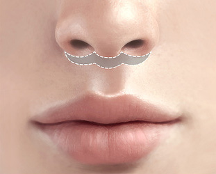 I Almost Gave Up Thinking My Long Philtrum Was Genetic—Until I Finally Looked Into 21 Plastic Surgery image 3
