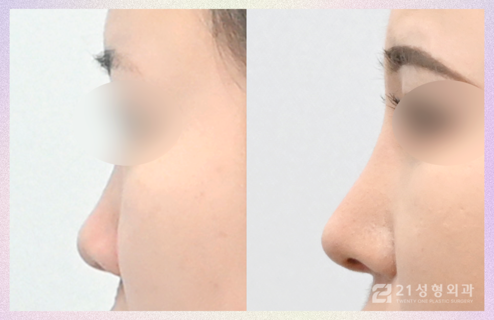 자가늑연골코성형 안전히고 아름다운 코 성형 관련 이미지 4