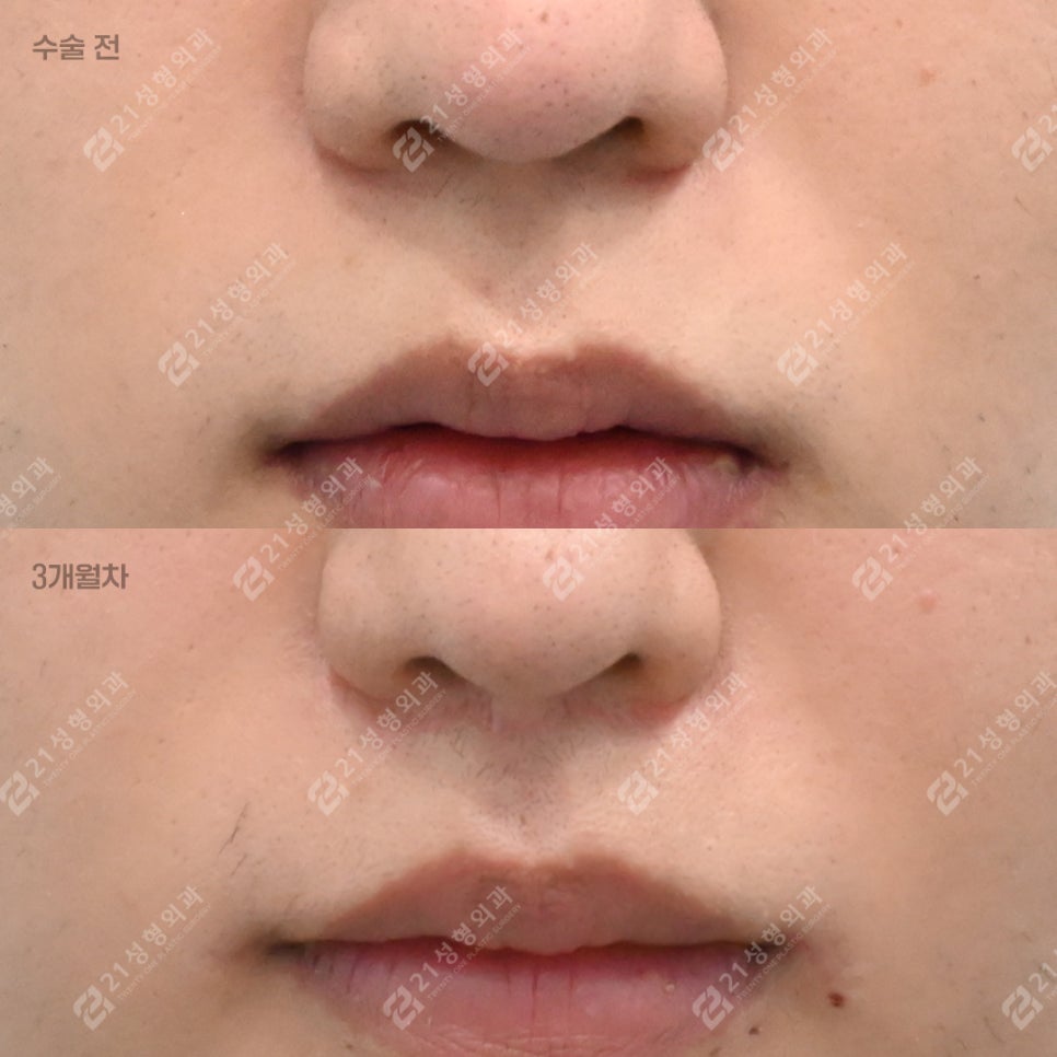 I Almost Gave Up Thinking My Long Philtrum Was Genetic—Until I Finally Looked Into 21 Plastic Surgery image 1