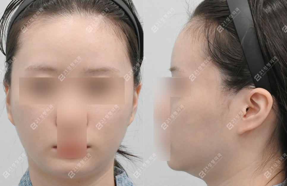 The Reason a Double Chin Appeared After Surgery Was Not a Fat Problem image 1