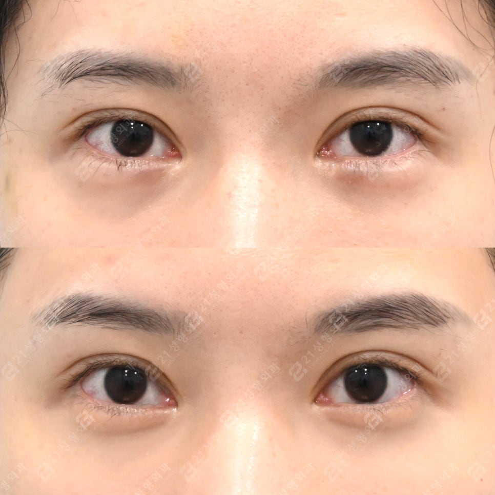 Why the under-eye area looks even more tired: your under-eye surgery may have gone wrong image 1
