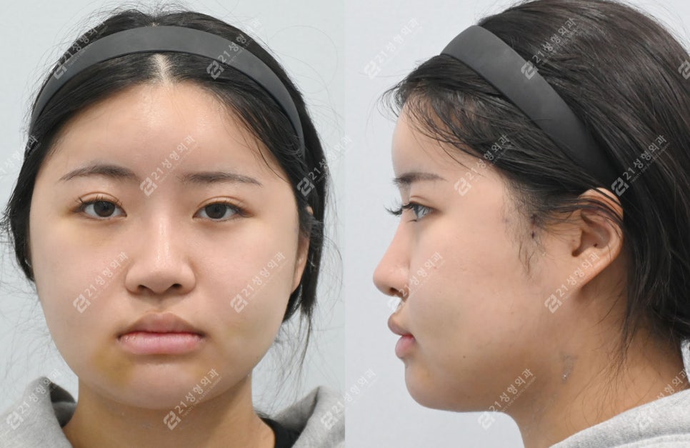 Real Review of Square Jaw Surgery: Square Jaw Surgery Is Not Over After Just Shaving the Bone image 4