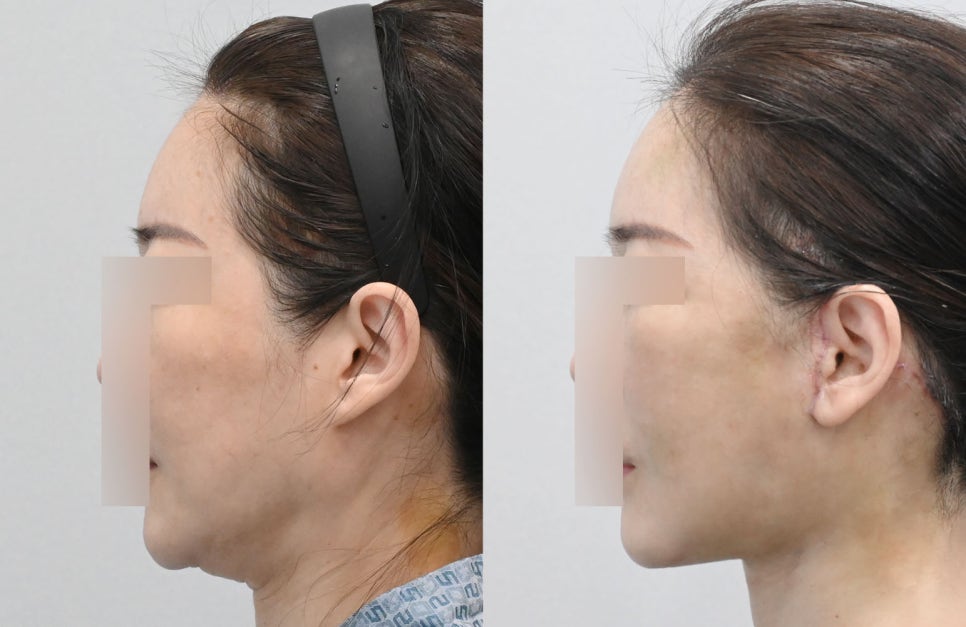 Natural Ear Lines Without Knife-Edge Earlobes: Facelift + Neck Lift Surgery Review image 7