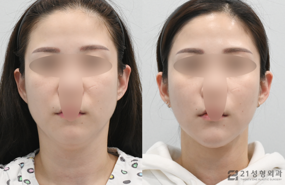 강남이중턱지방흡입, 빠른 효과를 기대한다면 관련 이미지 1