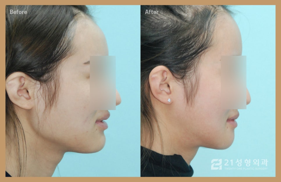 턱끝성형으로 양악 없이 주걱턱해결 관련 이미지 1