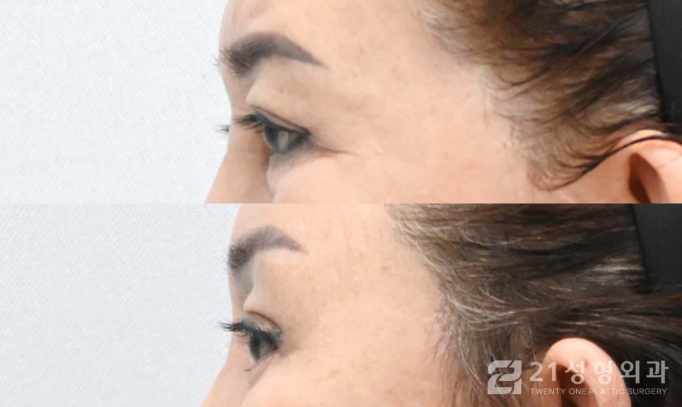 상안검수술흉터 안 보이게 하려면 관련 이미지 3