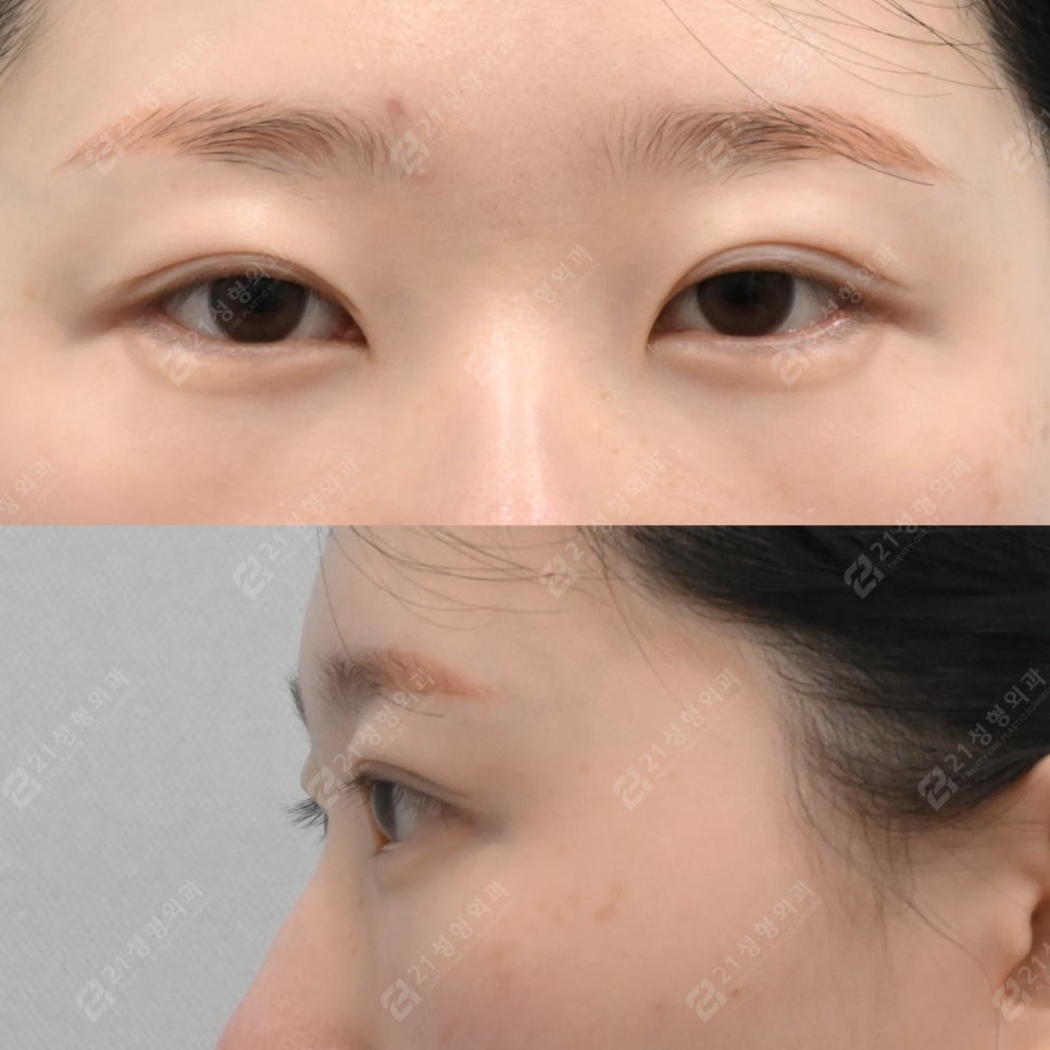 Recovery Period Before and After Lower Eyelid Fat Repositioning image 5