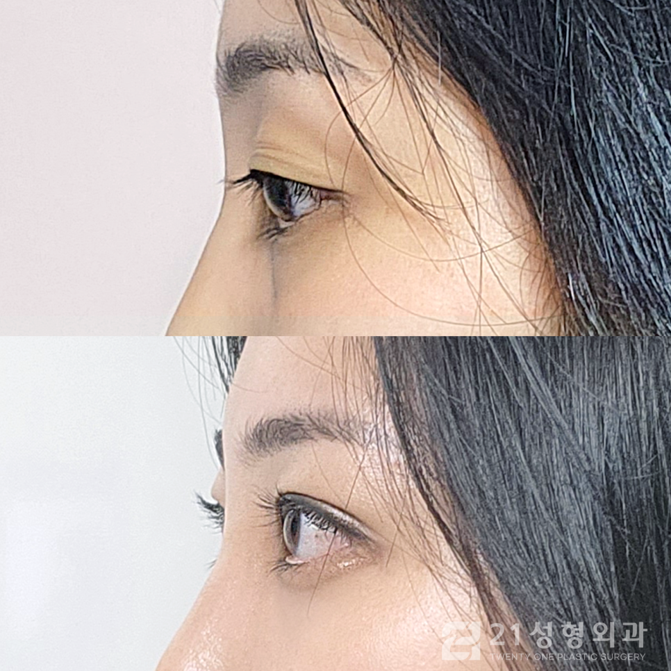 눈밑지방재배치잘하는곳 최고의 선택을 위해서는 관련 이미지 3