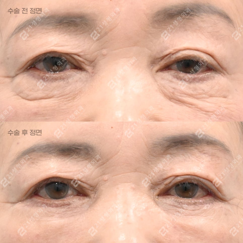 이거 모르면 하안검 수술 절대 하지 마세요! 관련 이미지 1